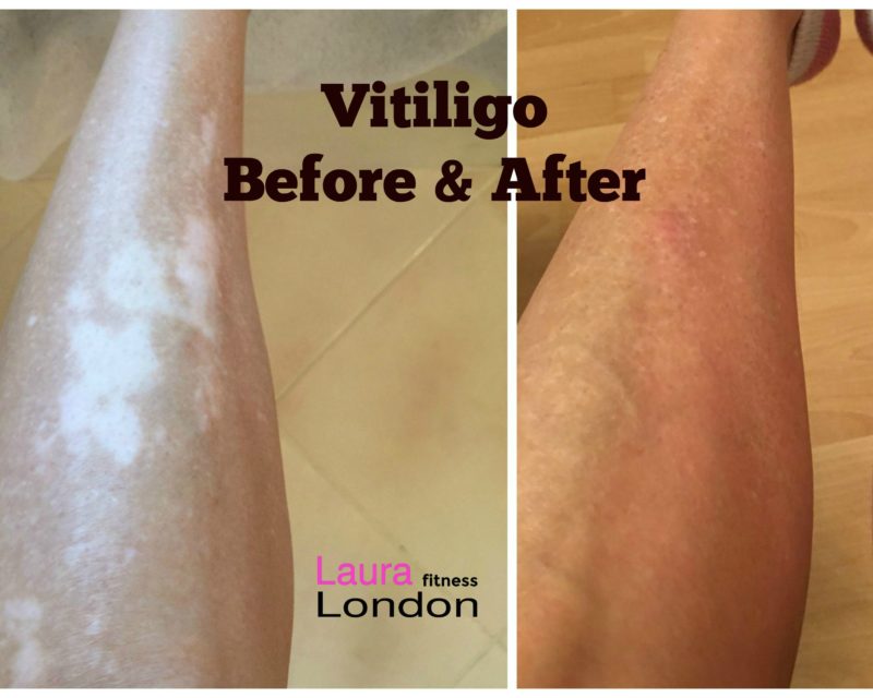 vitiligo & Medical Medium